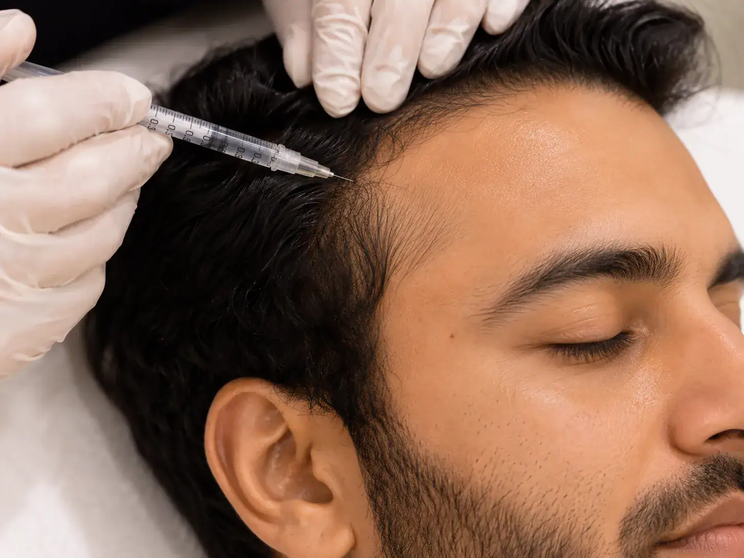 Exosome hair regrowth treatment with scalp microneedling in Andheri West Mumbai