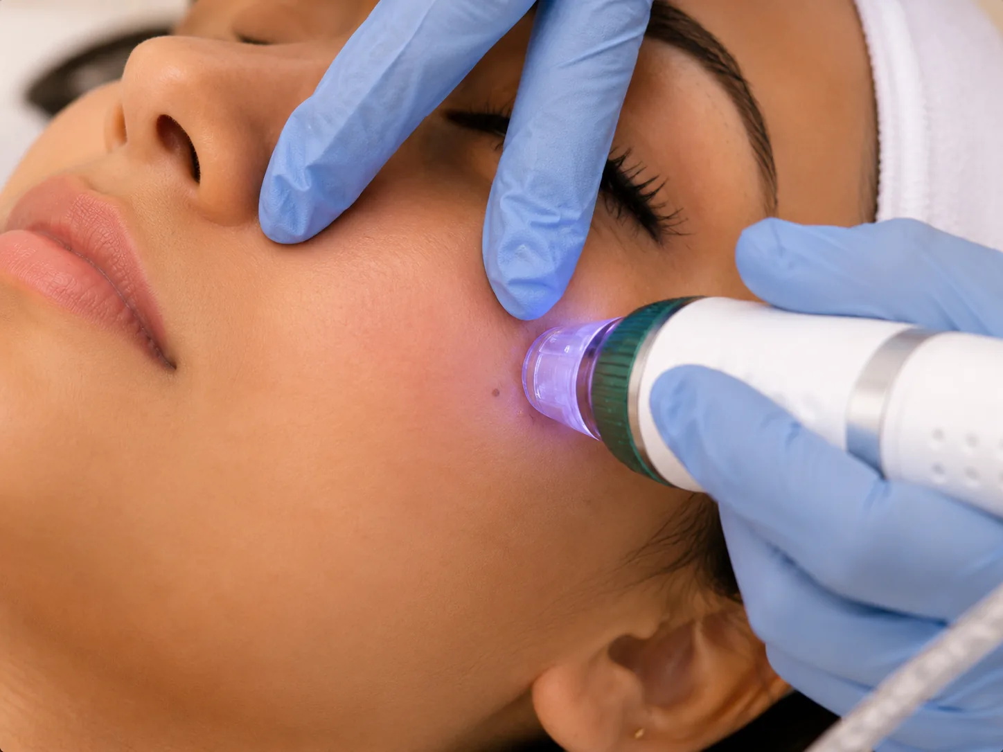 Microneedling and skin resurfacing treatment in Andheri West Mumbai