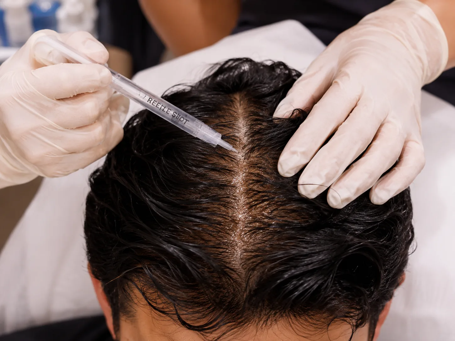 PDRN Reedle scalp treatment for hair regrowth in Andheri West Mumbai