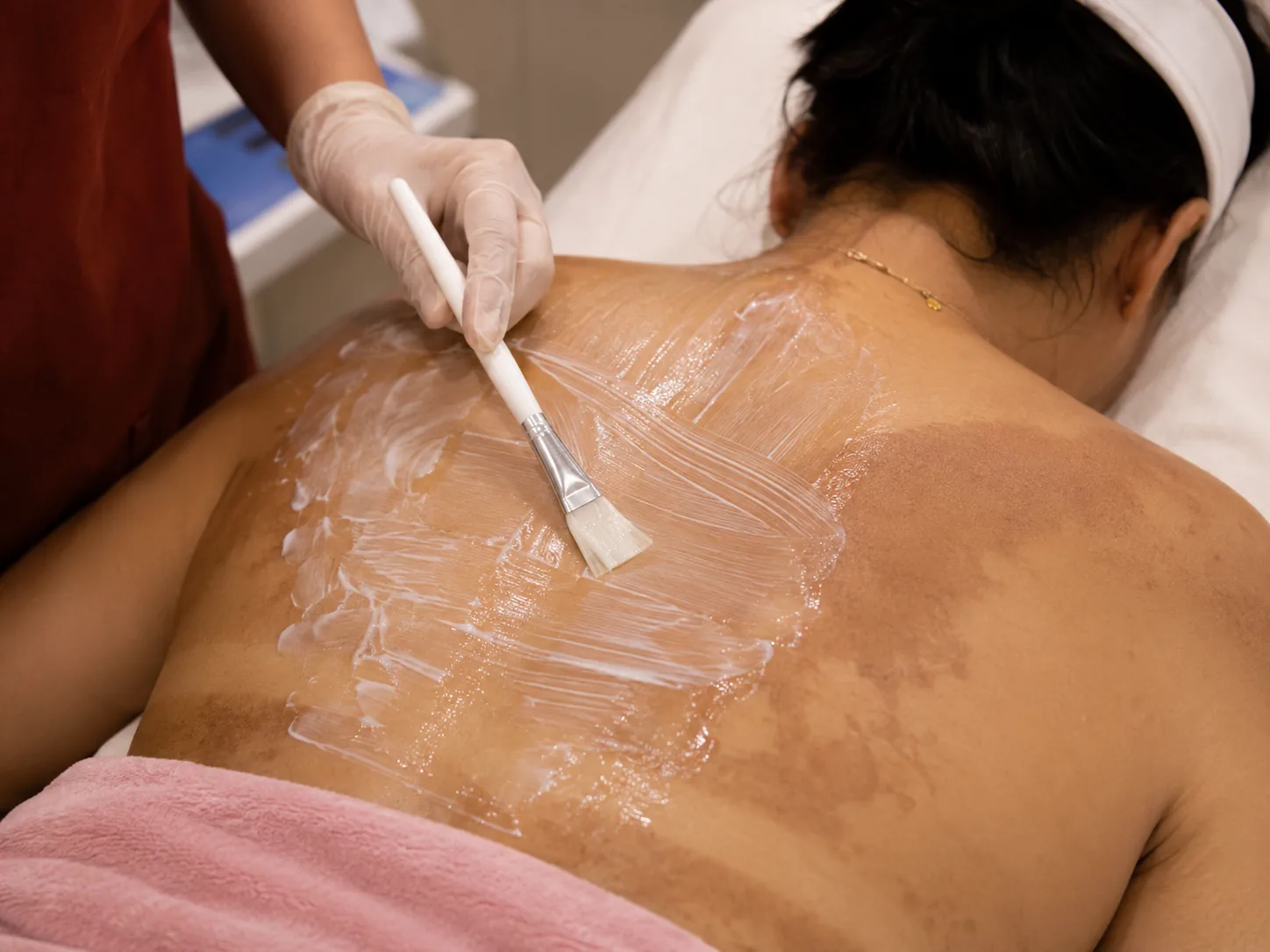 Synergy body peel for dark underarms and body pigmentation in Andheri West Mumbai